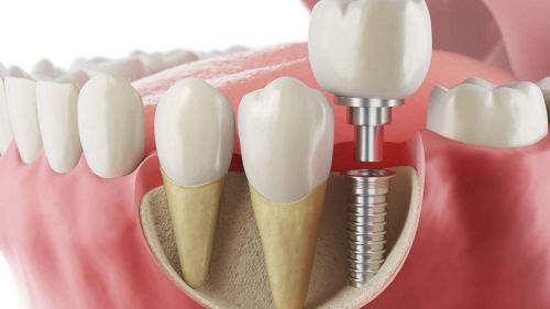 implant Tedavisi Hakkında Bilinmesi Gerekenler